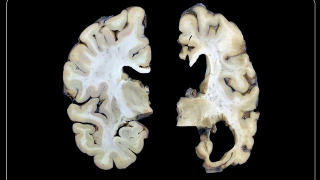 Bir neçə yeni tədqiqatın nəticəsi: bu sadə gündəlik vərdişlər demensiya riskini artırır
